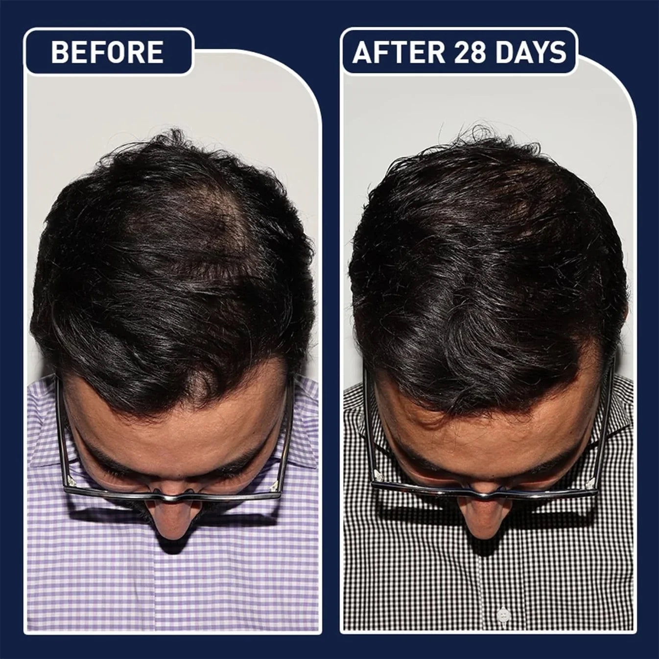 FEG Hair Growth Spray Plus Derma Roller For Both Men and Women